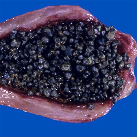 Image result for How to Remove Gallbladder Sludge