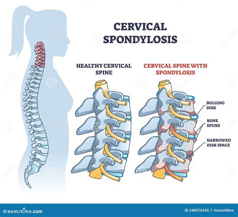 Cervical Spondylosis Problem Compared with Healthy Spine Outline Diagram Stock Vector ...