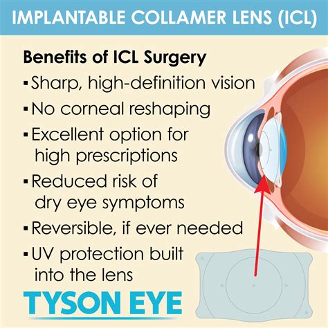 ICL Surgery | Tyson Eye