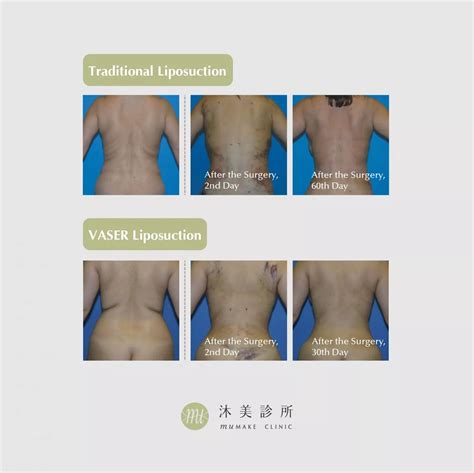 VASER Liposuction - muMAKE CLINIC | muMAKE CLINIC 沐美醫美