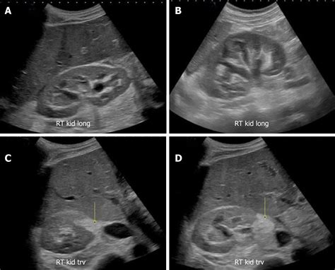 Normal Kidney Ultrasound