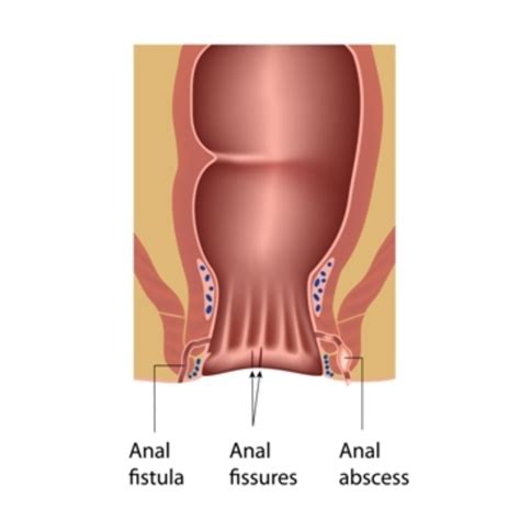 Ischiorectal Abscess Fistula Anal Fistula Treatment Newcastle NSW