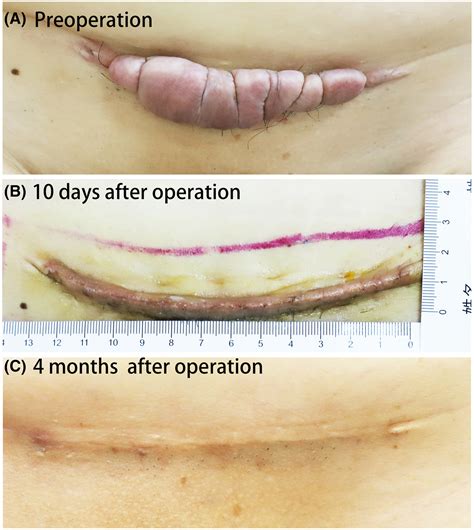 Multi‐gradient buried vertical mattress suture, an effective suture ...