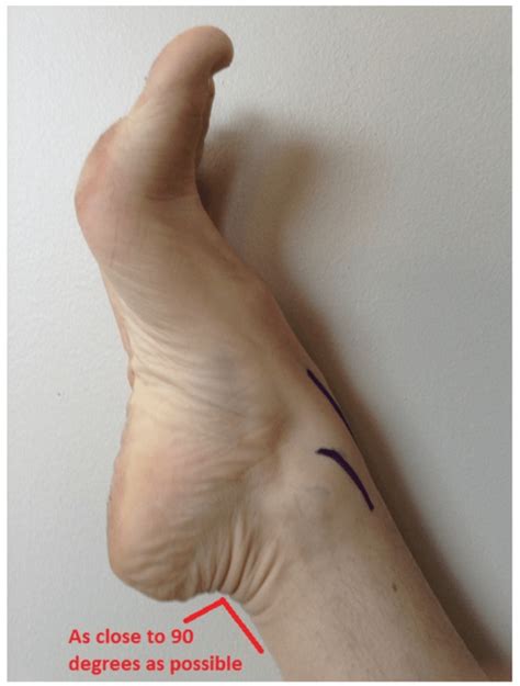 Image result for Ankle Injection Lateral Approach