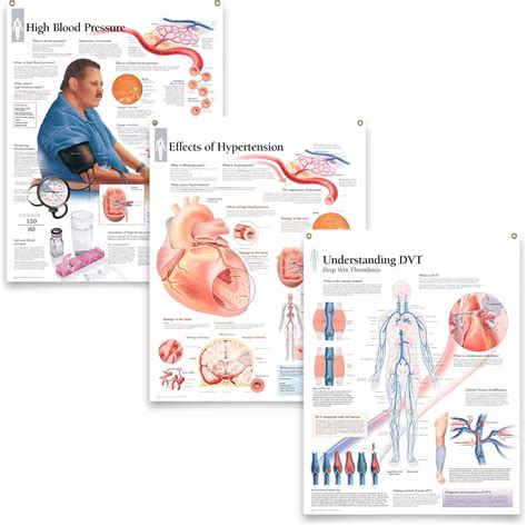 Buy Set of 3 Laminated Medical Posters High Blood Pressure, Effects of ...