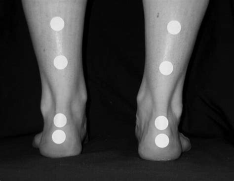 Bilateral Measurement of Resting Calcaneal Stance Position and Tibial ...