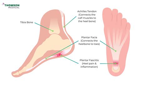 Why Do My Heels Hurt