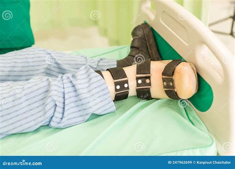 Orthopedic Boot To a Patient. Heel or Foot Have Broken Bone with Put on a Cast Stock Image ...