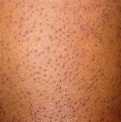 Keratosis Pilaris - Pictures, Treatment, Symptoms and Causes | HubPages