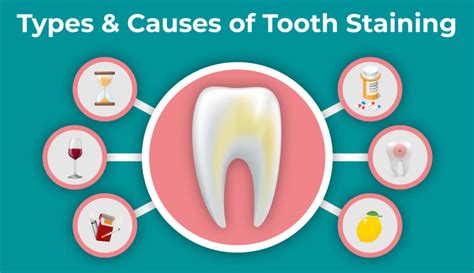 Image result for Teeth Staining Causes
