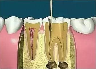 做根管治疗杀死牙神经后，牙齿还能用多久？ - 知乎