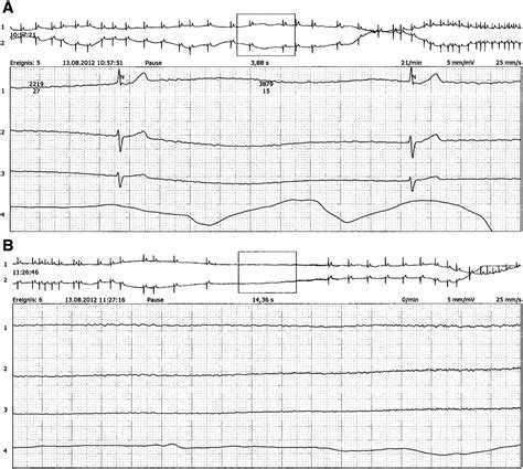 Polymorphic ventricular tachycardia after amiodarone infusion in extreme tachycardia–bradycardia ...