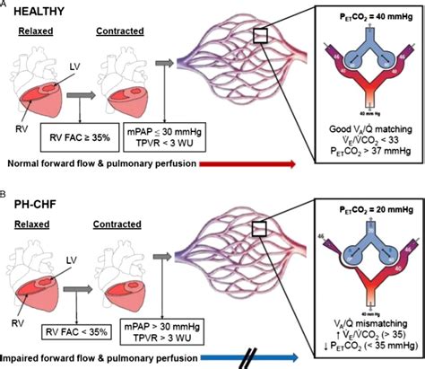 ️ Engorgement of the bronchial vasculature due to increased pulmonary ...