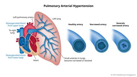 Pulmonary Hypertension: Causes, Symptoms, Treatment – EBRC