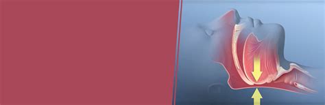 What is obstructive sleep apnea?