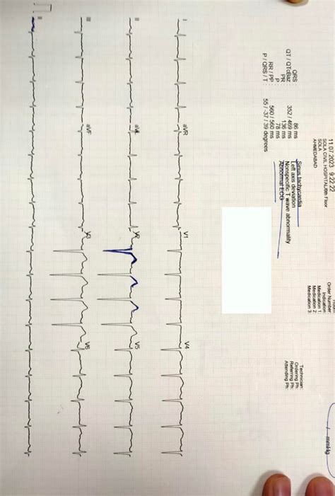 Are there any ischemic changes? Does poor R wave progression can be normal? : r/EKG