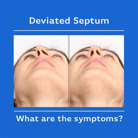 Deviated Septum — ENT & Allergy, Inc