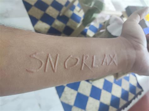 I have a skin condition called Dermatographia due to which lightly scratching my skin causes ...