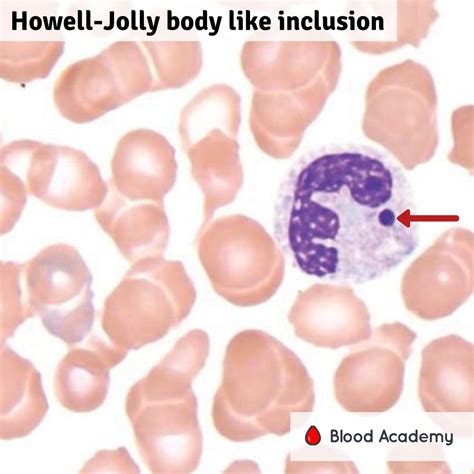 Howell-Jolly bodies in neutrophils | Blood Academy