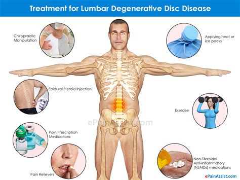 Types of Degenerative Disc Disease & Its Symptoms, Treatment ...
