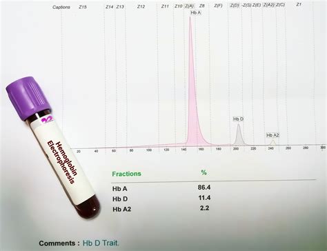 Hemoglobin Electrophoresis Comparable to KB Stain in HDFN