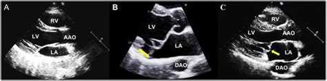 Arrhythmic Mitral Valve Prolapse: A Comprehensive Review
