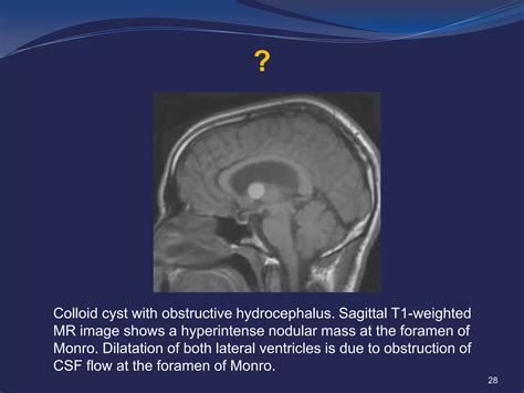 Hydrocephalus | PPTX