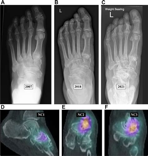 Classification Systems in Müller-Weiss Disease - Foot and Ankle Clinics