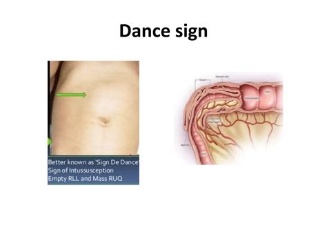 Image result for Definition of Intussusception