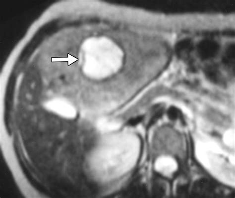 MRI of Atypical Focal Nodular Hyperplasia of the Liver: Radiology ...