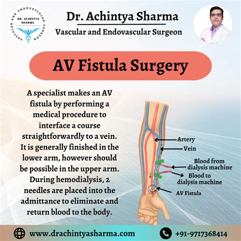 What Is Av Fistula For Dialysis at Harold Raines blog