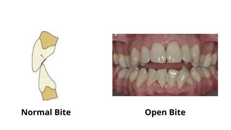 Open Bite: Your Guide to this Malocclusion