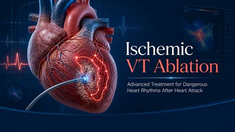 Ischemic Ventricular Tachycardia Ablation: Advanced Treatment for ...
