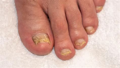 Curled Toenails Fix 的图像结果