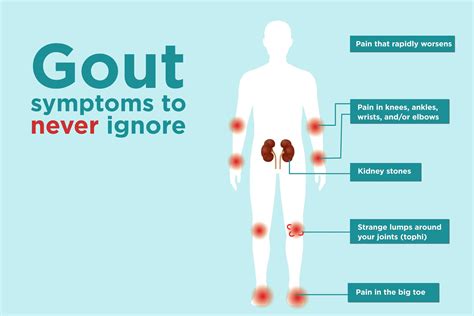 7 gout symptoms you might be ignoring – Artofit