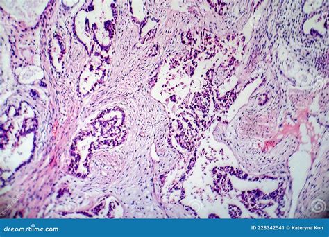 Teratoma, light micrograph stock image. Image of histology - 228342541