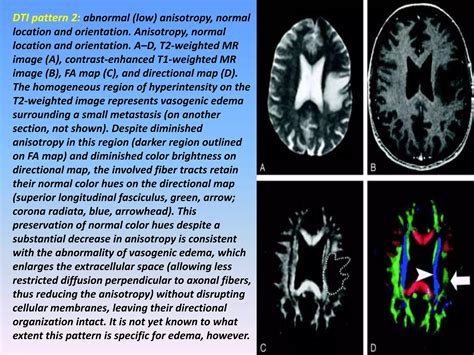 Image result for Diffuse Tensor Imaging
