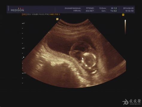 孕17周死胎头背部水囊 - 超声医学讨论版 - 爱爱医医学论坛