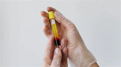 ¿Cómo se aplica el plasma rico en plaquetas? | Segundo Enfoque