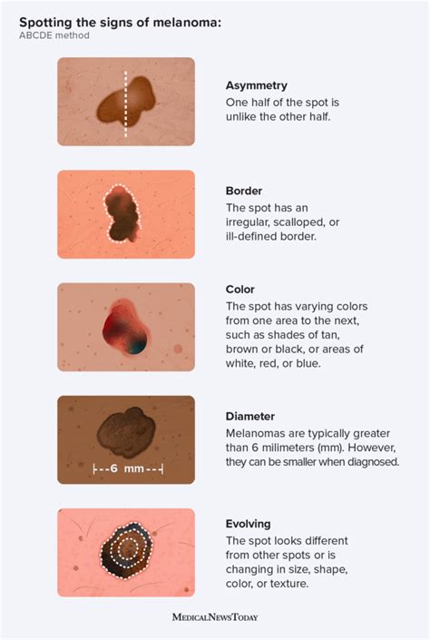 Types Skin Cancer Signs 的图像结果