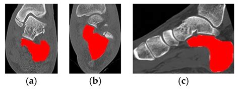 Real-Time Automated Segmentation and Classification of Calcaneal ...