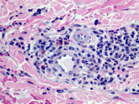 Dermal hypersensitivity reaction