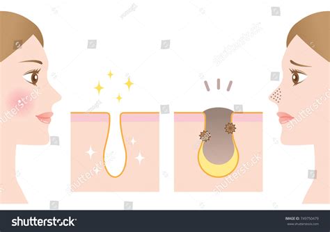 Clogged Pores On Nose