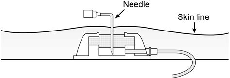 Image result for Intraperitoneal Therapy