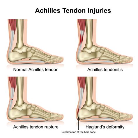 Signs Of Achilles Tendon Injury