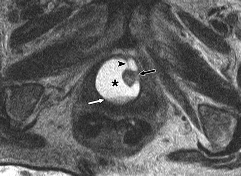 Pre- and Postoperative Evaluation of Urethral Diverticulum | AJR