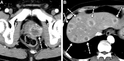 Liver Metastases: Correlation between Imaging Features and Pathomolecular Environments ...