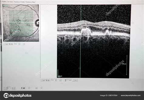 Optical Coherence Tomography Oct Showing Beginnings Macular Degeneration — Stok Foto ...