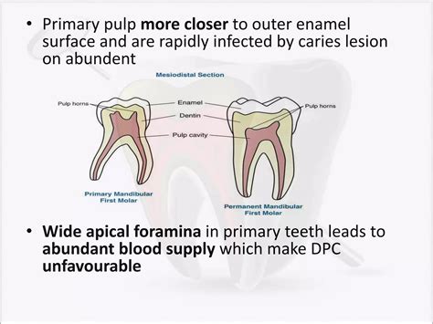 Image result for Direct Pulp Capping Vs RCT