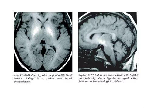 Amol toxic and metabolic encephalopathy syndrome | PPTX